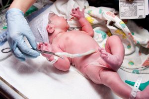 Caring for baby's umbilical stump