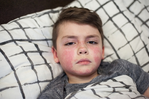 Scarlet Fever: Symptoms, Causes and Best Treatment